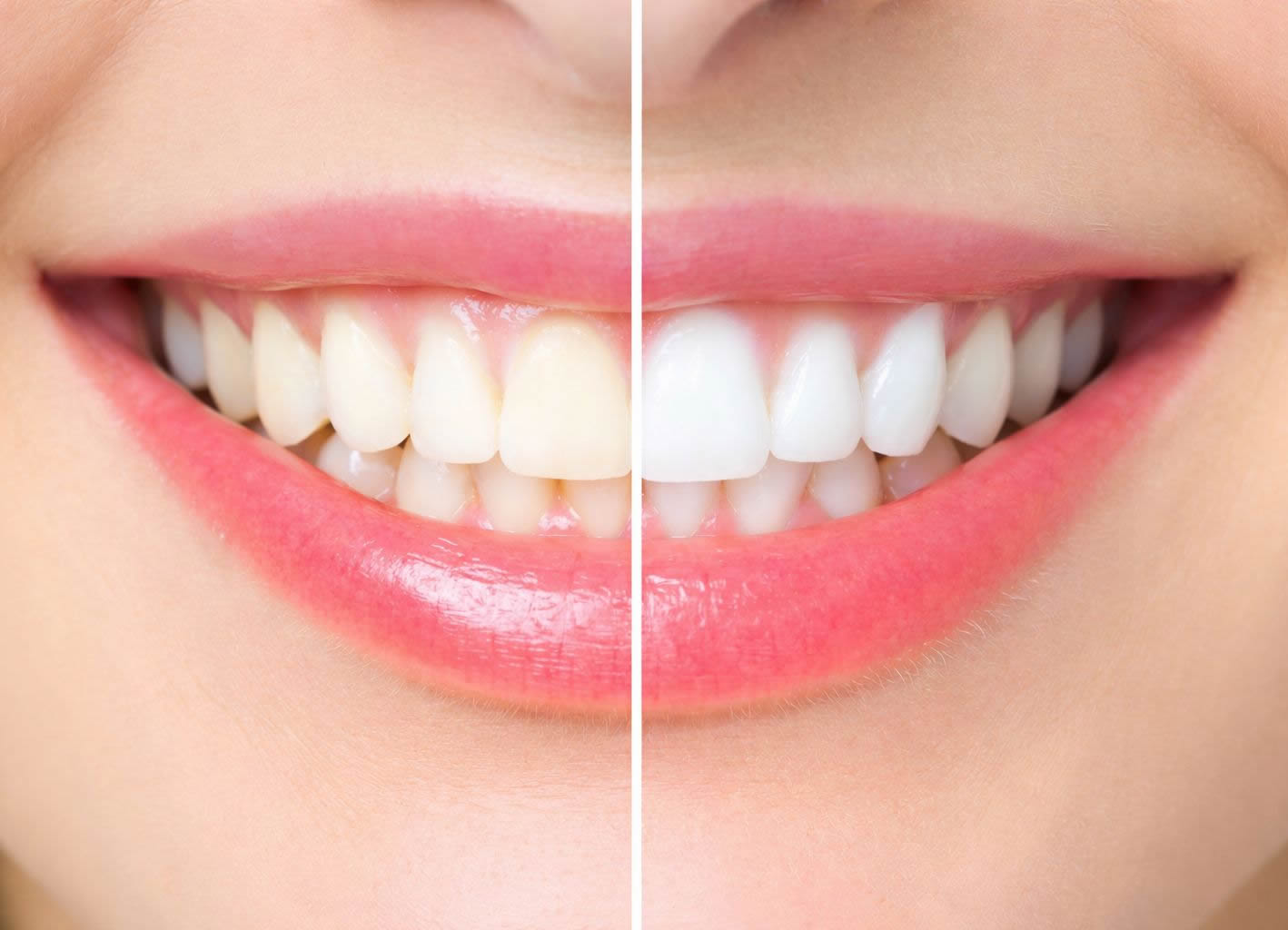 Clareamento dental em Contagem MG